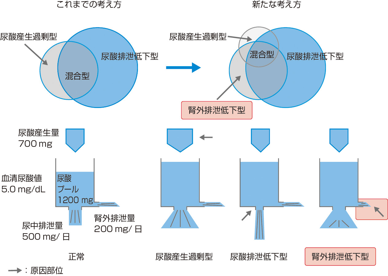 図1　高尿酸血症の新たな病型分類 (高尿酸血症・痛風のガイドライン改訂第3版より改変)． 