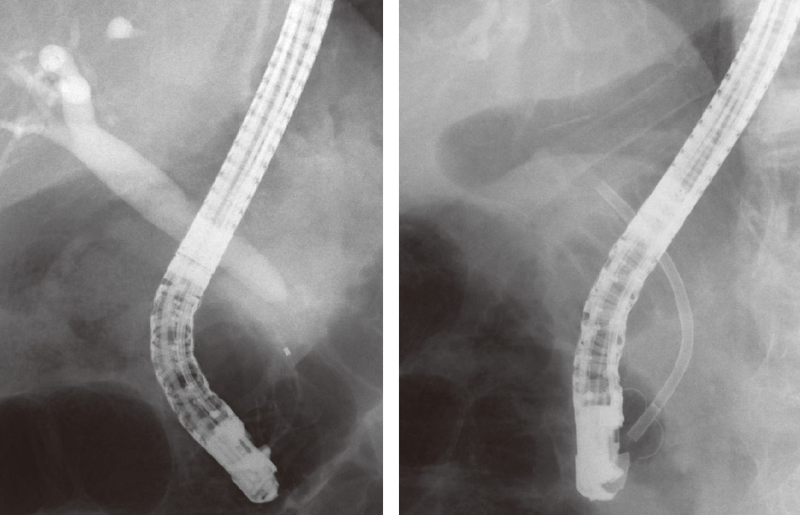 ⓔ図12-25-12　チューブステントによる内瘻化 良性胆管狭窄に対しプラスチックステントを留置した．