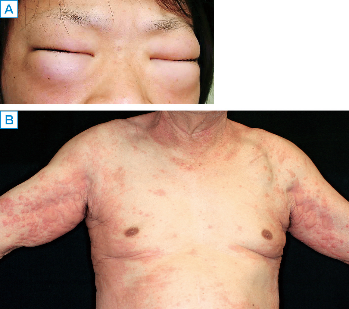 ⓔ図13-28-1　アナフィラキシー患者の皮膚症状 (福島県立医科大学医学部皮膚科学講座 花見由華先生より提供) A. 眼瞼浮腫：開眼しにくいほどの著明な浮腫を両眼瞼に認める． B. じんま疹：頸部，体幹，両上肢にかけて広範に大小不同の融合傾向が強い膨疹を認める．