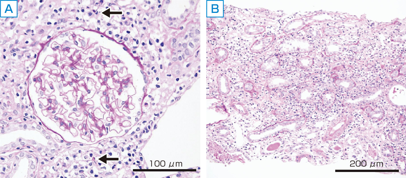 ⓔ図14-13-3　ⓔ図14-13-2と同じ薬剤性の急性間質性腎炎の患者における腎組織所見 (PAS染色) (Akimoto T, Horikoshi R, et al: Saudi J Kidney Dis Transpl, 2014; 25: 864–868 より作成) A：糸球体は正常であるが，間質に矢印のように好酸球が散見される． B：間質広範に単核球の浸潤がみられ，また間質の浮腫もみられる．