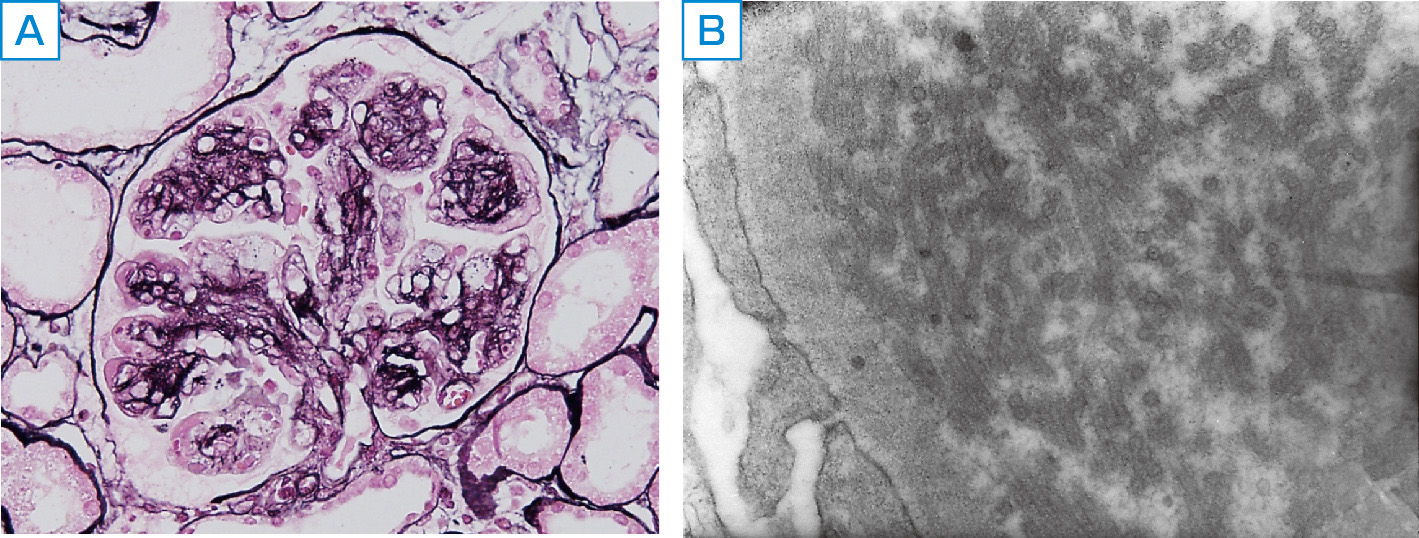 ⓔ図14-6-4　イムノタクトイド糸球体症の腎臓病理所見 A：膜性増殖性糸球体腎炎様病変 (PAS染色，×400)． B：内皮下領域に認められる微小管状構造 (電子顕微鏡，×8000)．