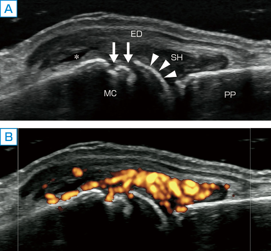 ⓔ図5-44-12　70歳女性，関節リウマチ (リウマトイド因子陽性，抗CCP抗体陽性) (千葉大学池田啓先生ご提供) 右中手手根 (MCP) 関節背側，縦断像． A：グレースケール画像では高度の滑膜肥厚 (SH) および軽度の滑液貯留 (星印) を認める．中手骨頭の硝子軟骨は消失し (矢頭)，骨びらん (矢印) を認める． B：パワードプラモード画像では滑膜肥厚に一致し，高度の血流シグナルを認め，骨びらん内にもドプラシグナルを認める． FD：伸筋腱，MC：中手骨，PP：中節骨．