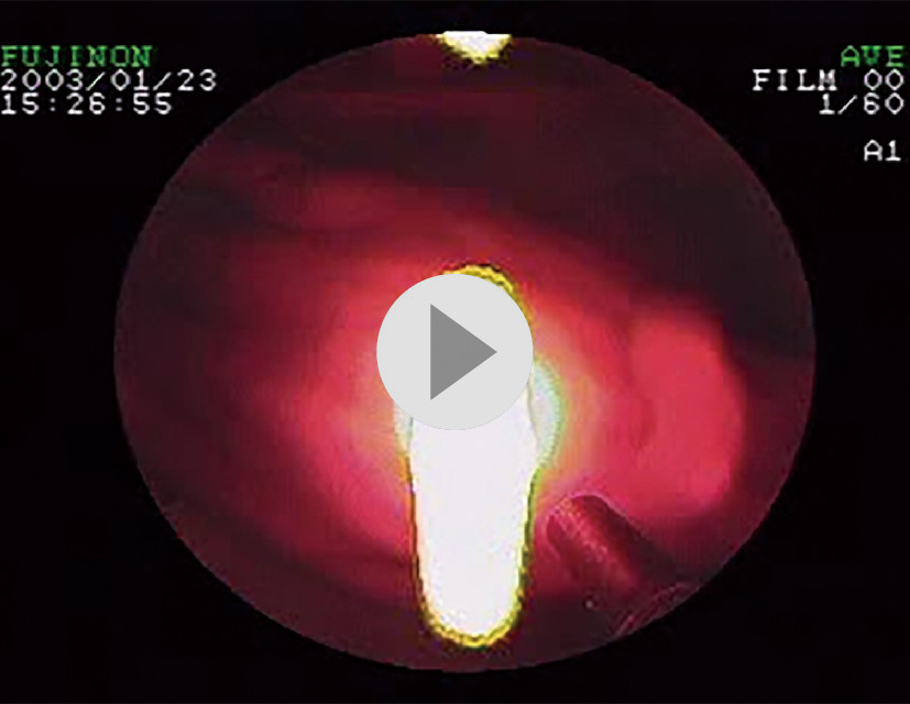 ⓔ動画11-1-2　補色カラーフィルター同時方式の電子内視鏡で観察したレーザー光 (630 nm，パルス波のエキシマダイレーザー) https://vimeo.com/658434535/c7861c829d